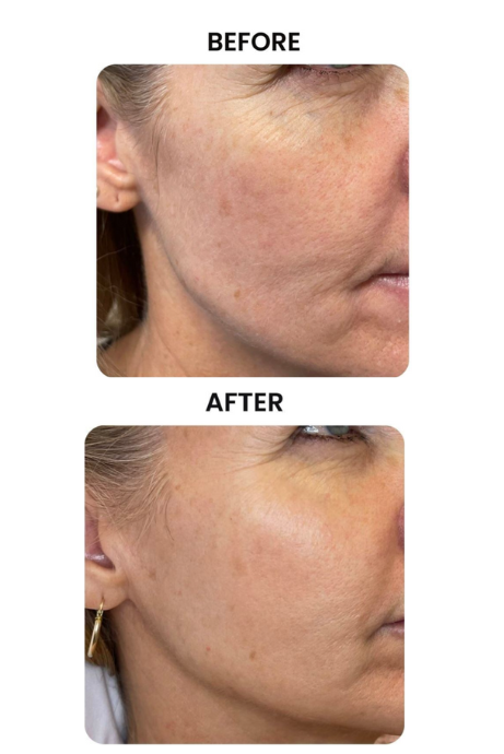 Before and after photos of a woman after a skin resurfacing treatment