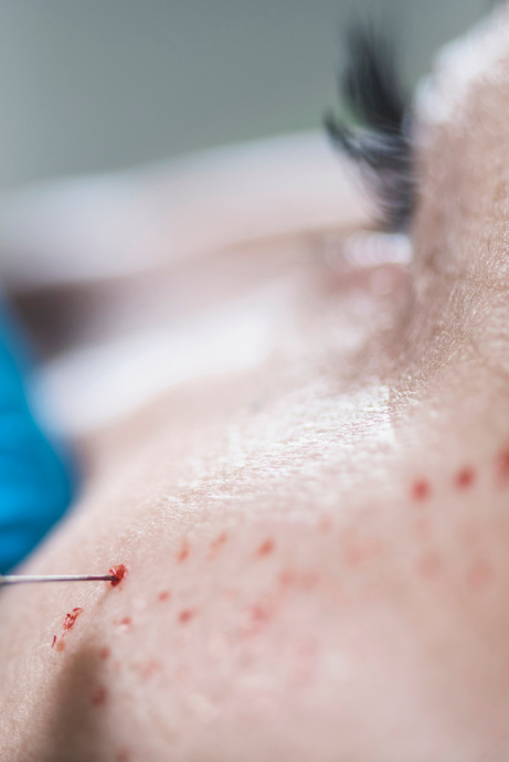 Woman receiving a Vampire Facial treatment